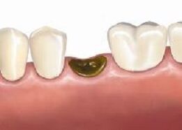 Complications après l'extraction des dents