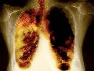 lésions pulmonaires lors de l'utilisation de la nicotine